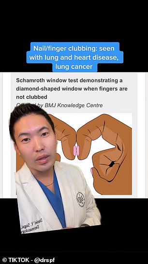 Dr. Daniel Sugai, a dermatologist in Seattle, said on TikTok that he recommends the test to check for clubbing