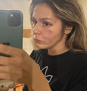 Mexican fighter Brianda Tamara showed off her injuries sustained during her 2022 fight with Khelif