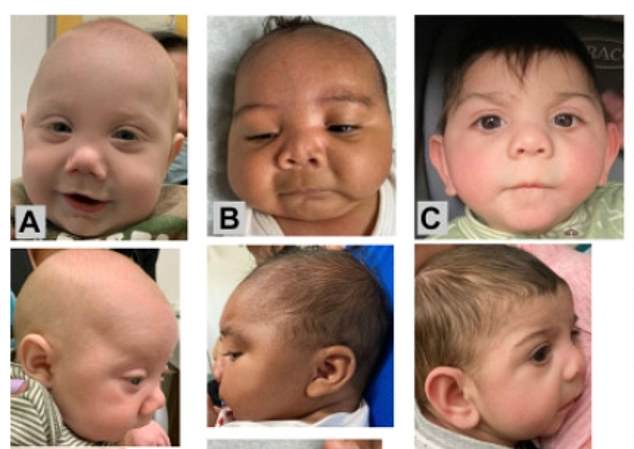 The babies affected by maternal fentanyl use generally had smaller heads and underdeveloped jawbones