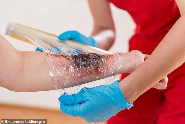 Cling film or plastic will not stick to the burn and reduces pain by keeping air away from the skin's surface (archive photo)