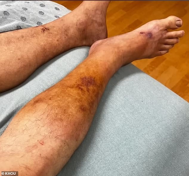 A previous scrape he had became infected with the flesh-eating bacteria, which is commonly found in the Gulf. The infection in Bunch's leg spread in the days before his death