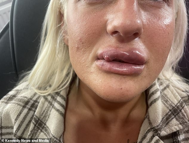 The mother of two had been using fillers and anti-wrinkle injections for the past decade without any problems, but these injections caused her cheeks to swell and eventually her lips to