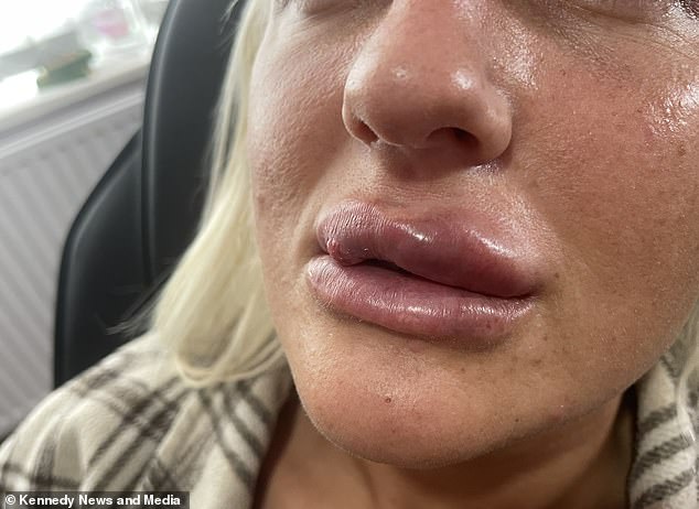 Concerned about a possible infection, she went back to her doctor who advised her to go to hospital, where they warned Mrs McManus that they would have to cut away part of her cheek. But two weeks later her lips also swelled up