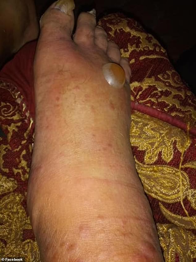 After Adam Perez dipped his toes in the water at a Corpus Christi park, his foot and leg swelled up and a giant blister formed, a result of vibriosis