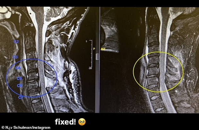 He also posted x-rays showing the extent of the internal damage and his recovery