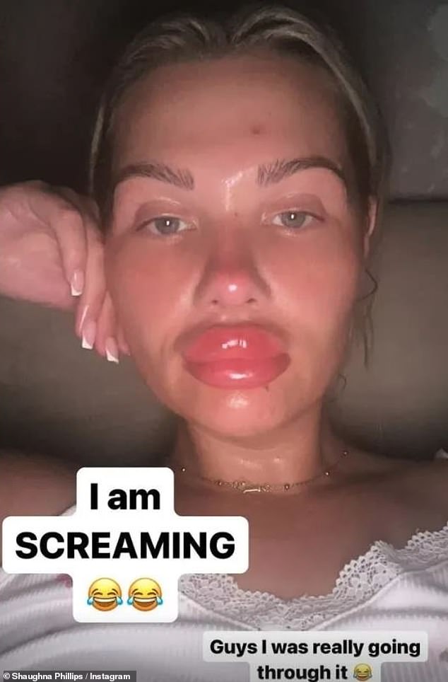 The former Love Island star, 30, took to social media to reveal she suffered from severe swelling following the cosmetic procedure