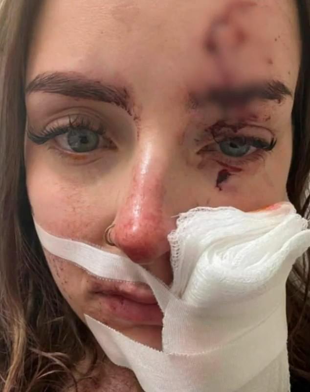 The 20-year-old (pictured) with a cut that just missed her right eye and a deep wound on her cheek