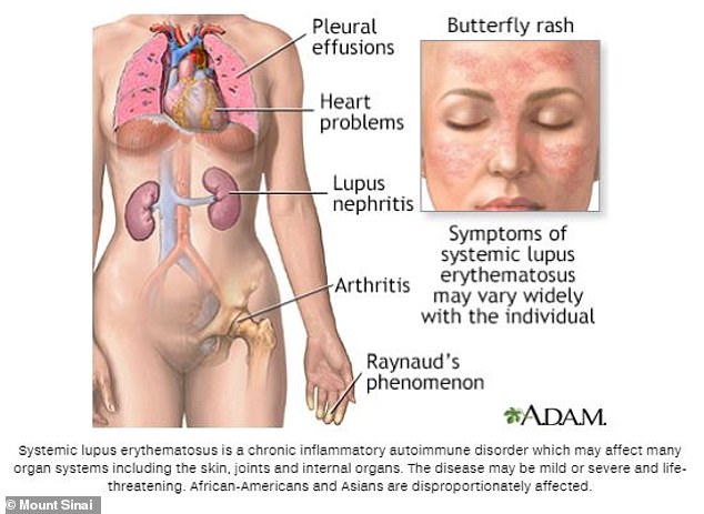 Symptoms of lupus include pleural effusions (a buildup of fluid in the lungs), heart and kidney problems, arthritis, and Raynaud's phenomenon (when fingers turn white or blue in response to stress or cold). A butterfly rash across the face is also a major sign