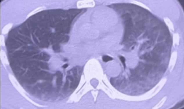 The CT scan of the chest showed hazy spots and shadow areas in the posterior parts of both lungs, with more significant findings on the left side. This indicates fluid accumulation in the lungs