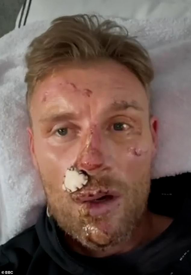 1723582302 348 Freddie Flintoff reveals just how bad his horrific injuries were