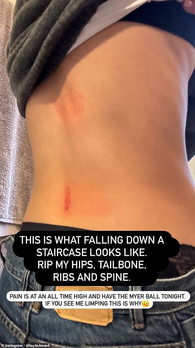 The popular AFL WAG posted a photo on Instagram of the damage done, lifting her shirt to reveal a graze along her spine and the beginnings of a large bruise