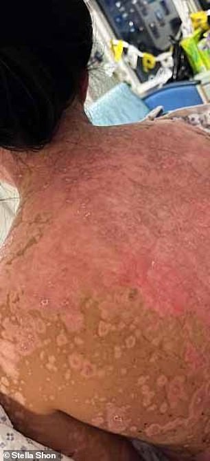 Above you can see the painful rash on her back as her skin has peeled off in layers