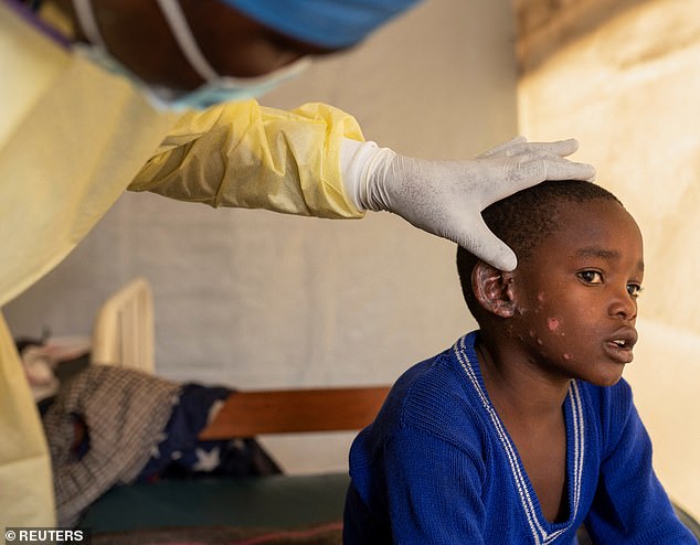 A child with skin lesions receives treatment at the treatment center in Munigi, DRC, on July 19