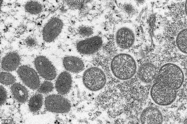 Mpox virions shown under a microscope. Experts warn that the new 1b Clade is harder to detect