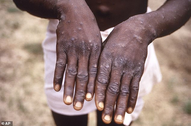 A 1997 image shows symptoms of MPOX in a patient in DRC, formerly Zaire