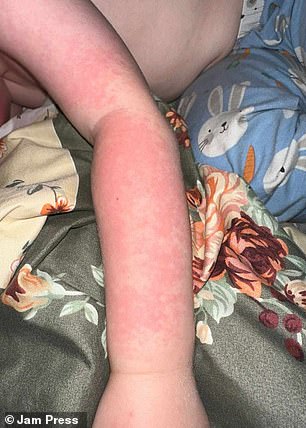 Cole Pugsley suffers from polymorphic light eruption (PMLE), which causes his skin to develop painful rashes and blisters, even after just a few minutes in the sun