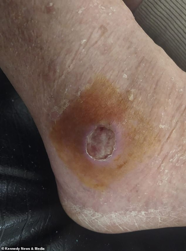 After two rounds of failed antibiotics and painkillers, she was referred to the hospital, where she was given compression bandages and tried three rounds of leech therapy to tackle the infection