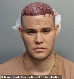 Hernandez-Garnier's arrest photo shows him with his bandages removed and blood streaming from his scalp after his hair transplant