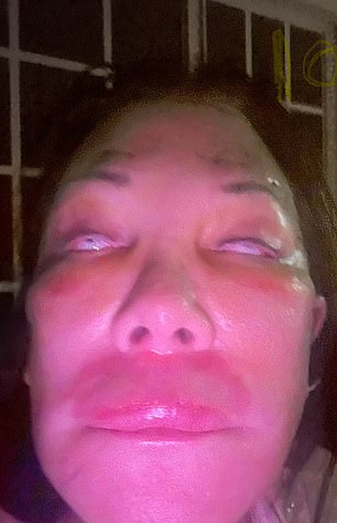 Dian Keller, 70, of Florida, paid $13,000 for a partial facelift — but said she was “screaming” in pain as soon as she woke up. Doctors say her surgeon pulled her skin too tight, preventing her eyelids from closing