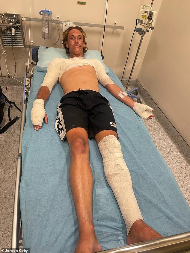 The young surfer suffered severe burns to his face, chest, arms, hands and legs (photo)