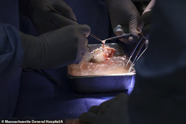 This year, a 62-year-old man in the US became the first living person to receive a genetically modified pig kidney in a groundbreaking operation. Pictured: Surgeons at Massachusetts General Hospital in Boston prepare the pig kidney for transplant in March 2024