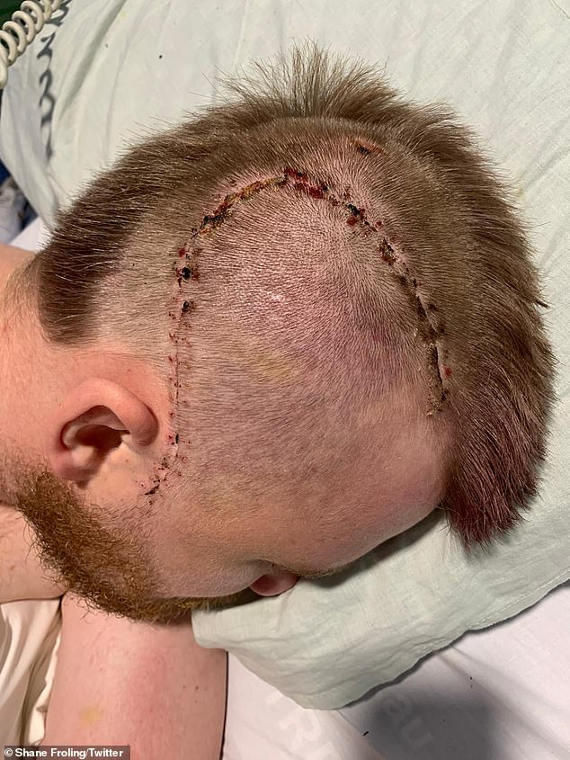 The shocking image shows the surgery needed to stop the bleeding in the brain