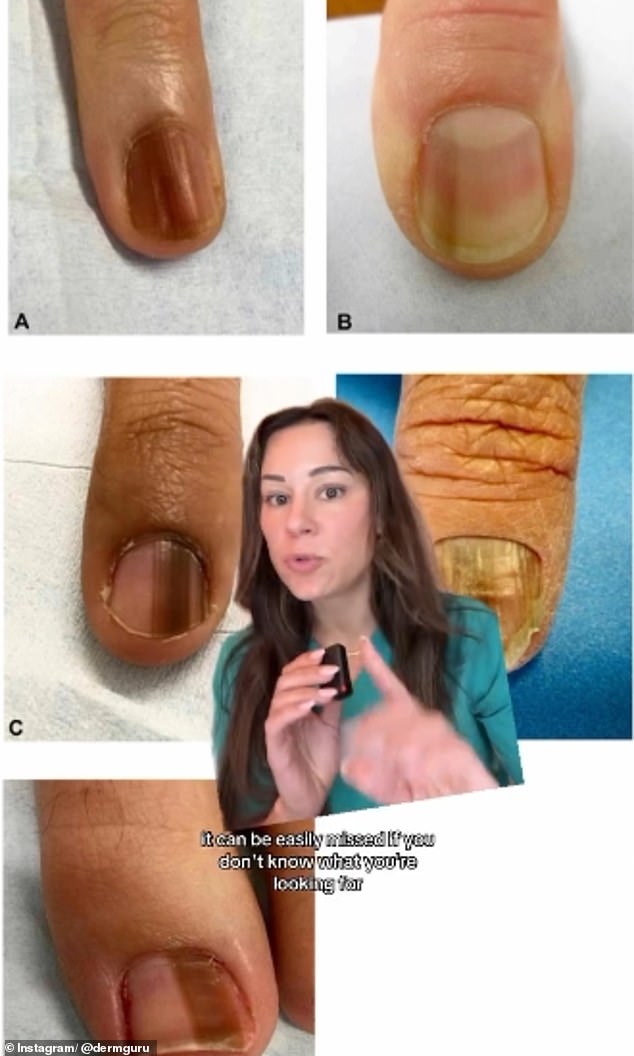 Subungual melanomas often appear as a dark brown or black streak. The nail may also thicken, separate from the nail bed, and split in the middle because of the cancer, accounting for about one in 30 melanoma cases