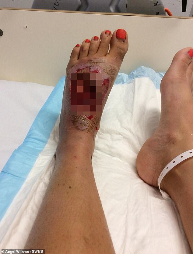 The bicycle stand pierced her left leg (photo)