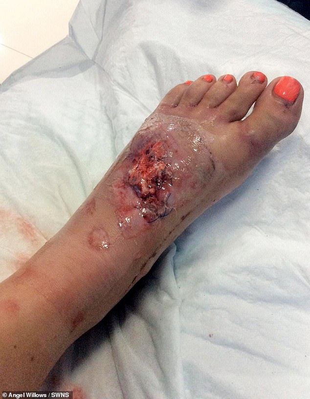 Australian doctors had to transplant skin and flesh onto her left foot