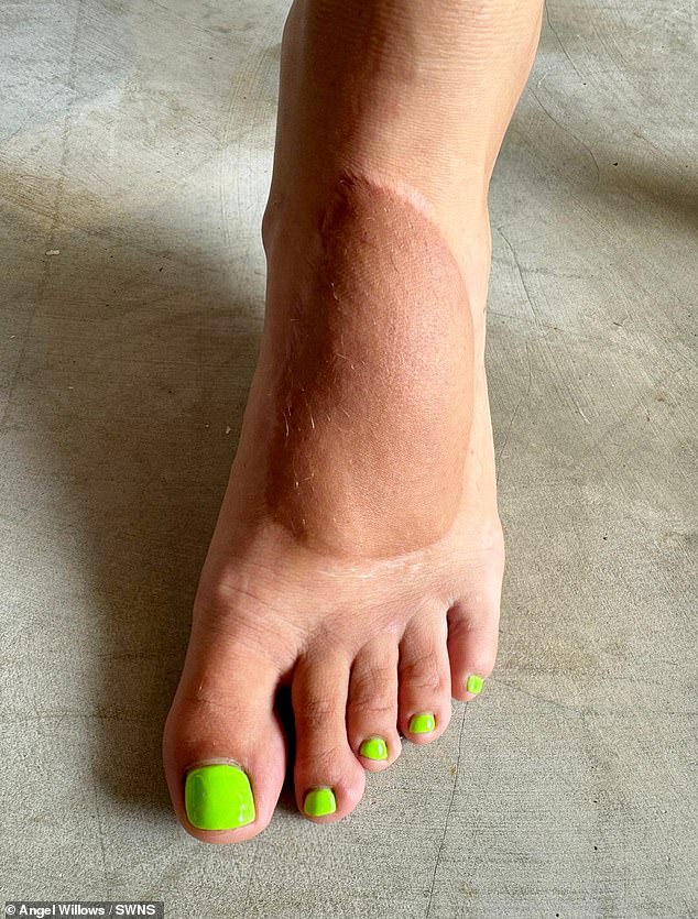 A few years later, the only sign of her accident is the skin mark on her foot