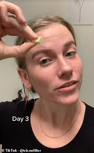 A TikTok user applied garlic directly to the pimples on her skin