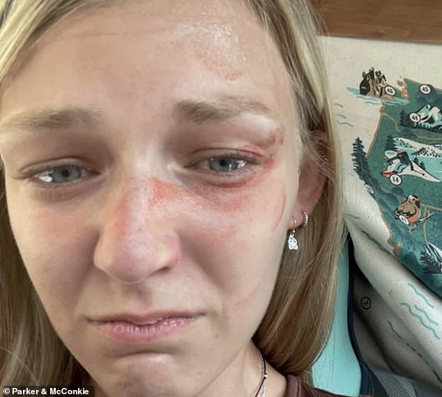 A photo shared by attorneys for Gabby's family, who are filing a lawsuit against police in Moab, Utah, shows bruises Petito sustained before the traffic stop. The lawsuit alleges that police mishandled the incident