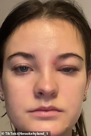 Last December, Dance Moms star Brooke Hyland, 25, accidentally popped a pimple in this triangle, leaving her with an inflamed eye.