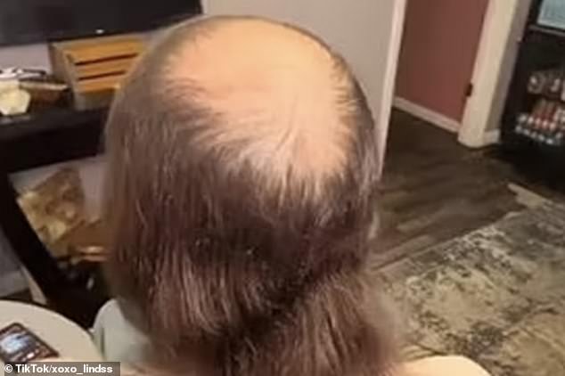 A young man, who has been bald since his teenage years, has become unrecognizable after having his hair cut by his sister