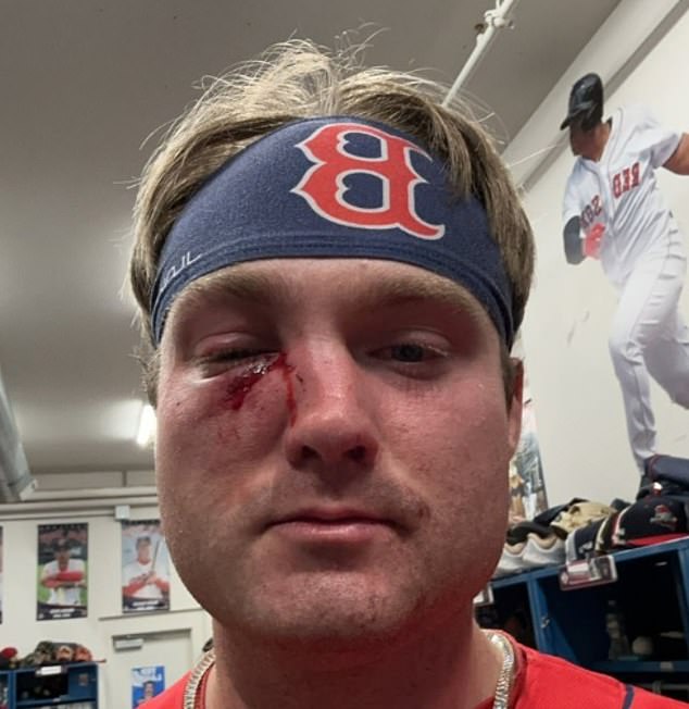 Boston Red Sox prospect Blaze Jordan recovers after taking a 97 mph fastball off his