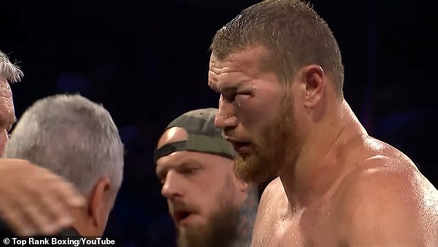 Arslanbek Makhmudov showed his serious eye injury after the loss to Guido Vianello on Saturday