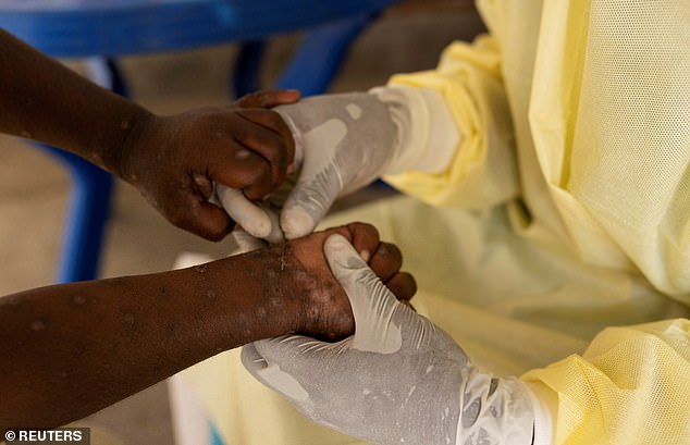 Christian Musema, a laboratory nurse, takes a sample from a child suspected of having Mpox at the treatment center in Munigi, Democratic Republic of Congo