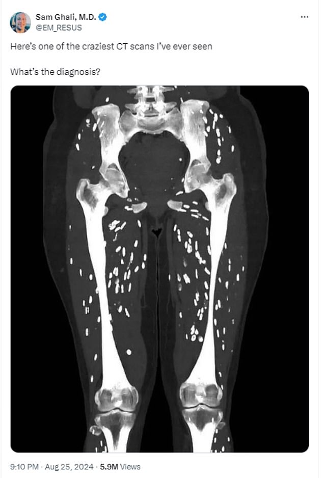 Dr. Sam Ghali, an American healthcare worker, shared a photo of an anonymous patient with clear signs of a parasitic infection called cysticercosis