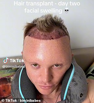 Bimini posted on TikTok saying the swelling in his face was “a natural part of the healing process”…