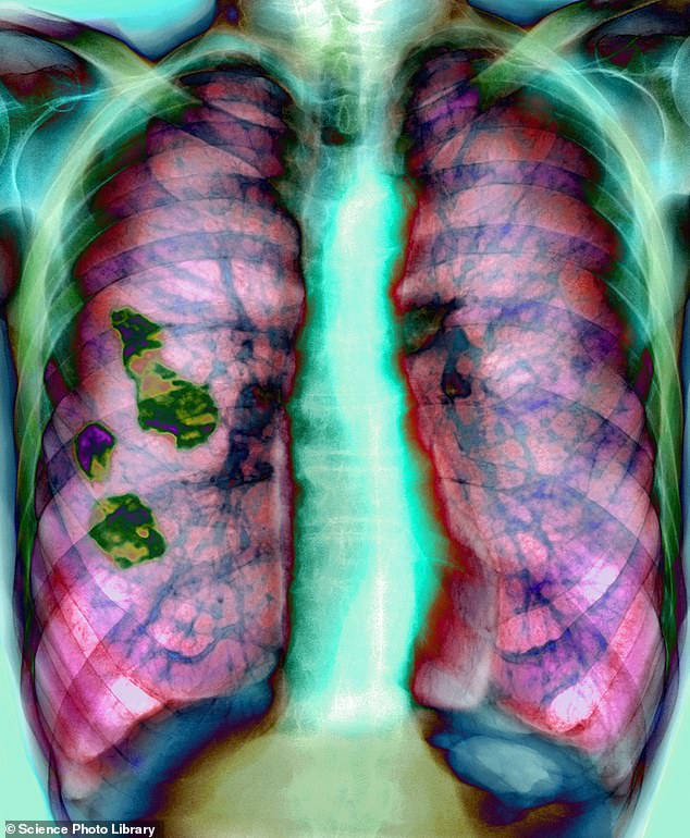 Emphysema occurs when the tiny air sacs ¿ or air sacs ¿ in the lungs become damaged and no longer function properly. Chronic bronchitis is a long-term inflammation of the airways and many people have both problems, so they are not mentioned under the same umbrella term.