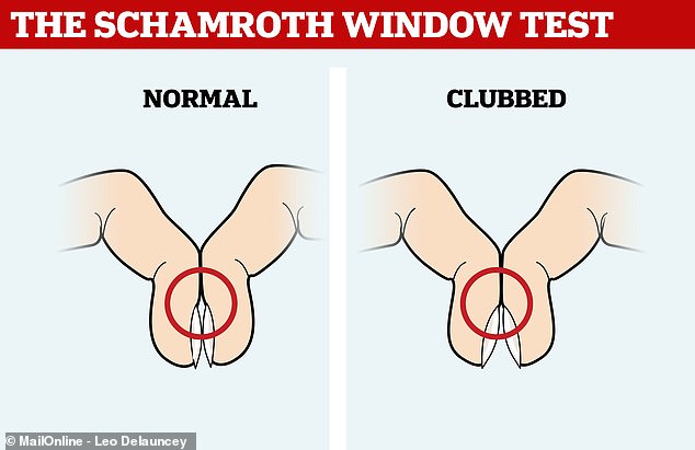 Healthy people should have a diamond-shaped gap between their fingernails when they press them back to back. If that gap is gone, it could be a sign that someone has clubbed fingers, which is a symptom of lung cancer.