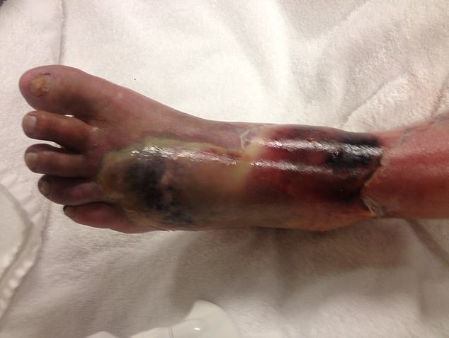 It took more than a week before nurses could intervene on her growing necrotizing fasciitis infection (pictured) and finally call a surgeon