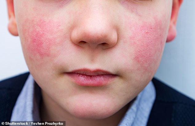 Parvovirus B19 causes a characteristic 'slapped cheek' rash in children. Once the rash appears, patients are no longer contagious