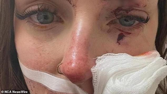 Taiya Sampson, 20, was left with a deep cut to her cheek that required surgery (pictured) after she was reportedly pelted with glass during an altercation at a Perth pub on Friday night