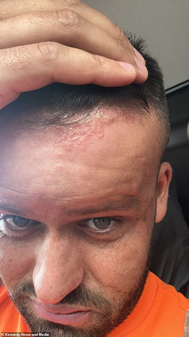 Ryan Briggs, from Blackburn, Lancashire, initially thought the worst he would get from a hair dye that didn't suit his scalp was a nasty rash