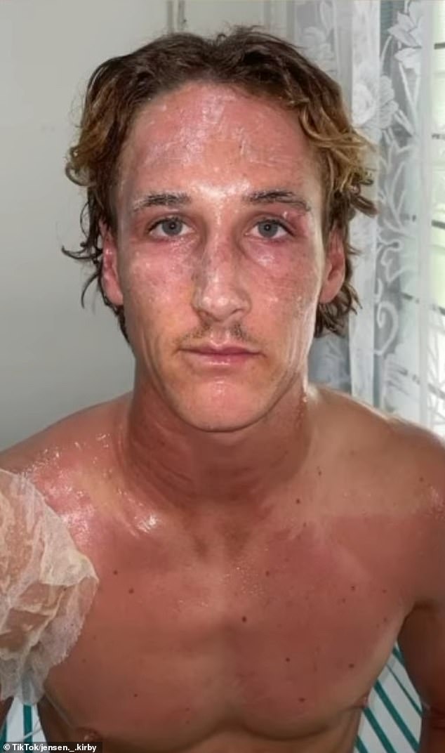 Jensen Kirby, 19, suffered burns to 13 percent of his body after the speedboat he was on exploded near the Telos Islands off the west coast of Sumatra, Indonesia, on August 11.