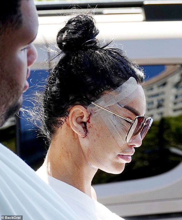 A disgruntled tourist has slammed Katie Price, claiming the star ruined their stay at a five-star hotel in Turkey after she arrived with a bloodied and bruised face following facial surgery