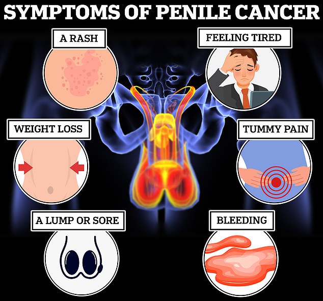 Penile cancer is rare in the UK, with only around 760 new cases each year, according to Cancer Research UK. But the number of cases is expected to rise to 1,100 a year in the UK by 2038-2040. A growth or ulcer on your penis, a foul-smelling discharge, bleeding, a rash or difficulty retracting your foreskin are all telltale signs of cancer.