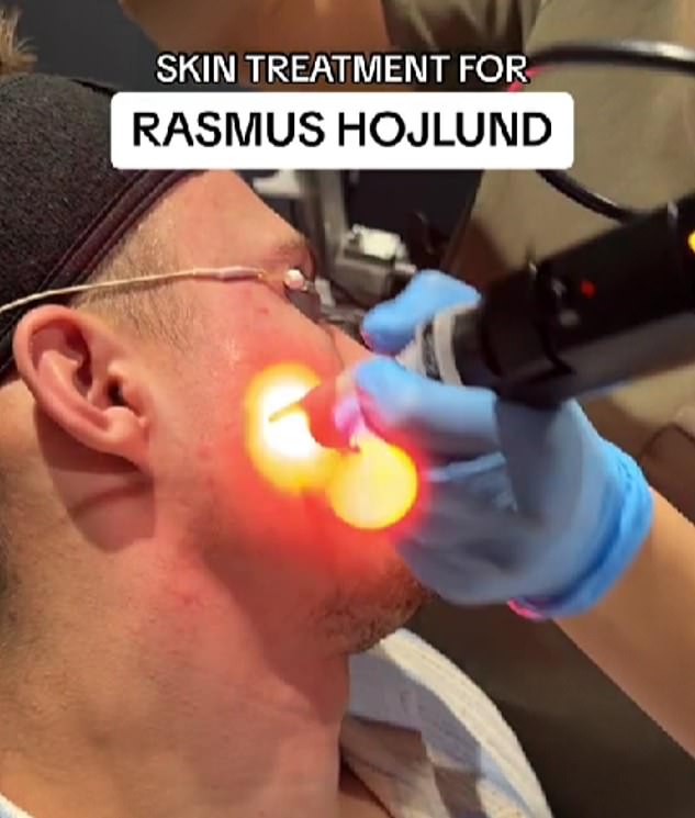 Man United star Rasmus Hojlund has been filmed getting an acne treatment worth over £1,099