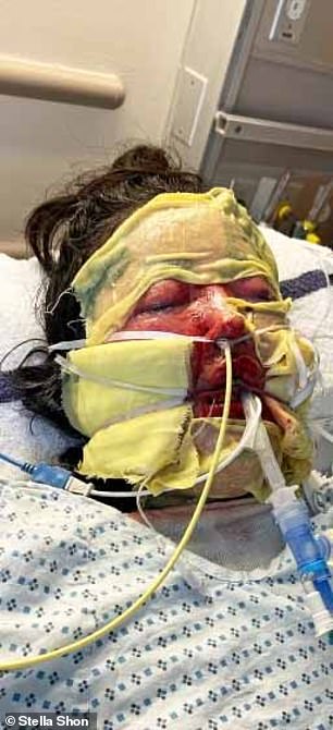 She is pictured above during her hospital stay. She said her eyes remained covered in crusts for months while she was being treated